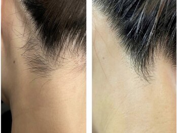 キックアス(KICK ASS)/うなじ脱毛 春 夏 清潔感