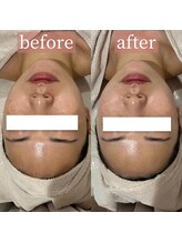 アディクトウラ(Addict'ula)/小顔マッサージ