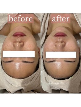 アディクトウラ(Addict'ula)/小顔マッサージ