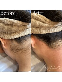 マベル シュガーリング(Mabelle)/うなじのW脱毛