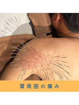 いつつのき/ルート鍼