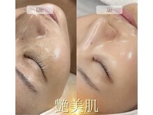 リッチアンビューティー(Rich.an beauty)/剥けないピーリング＆コラーゲン