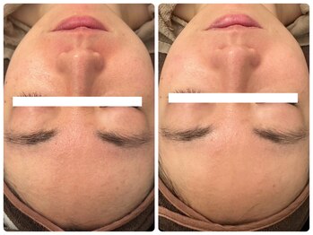 メゾンリュバン 梅田店(Maison Ruban)/ハーブピーリング｜くすみケア