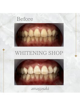 ホワイトニングショップ 尼崎店/セルフホワイトニング1回の効果