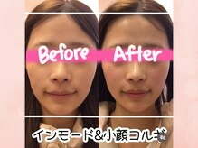 サロン ド シャーロット 恵比寿/韓国最新美容＃インモードリフト