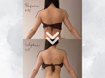 サイバーエステ 宇都宮店/3回でキレイな肩のライン