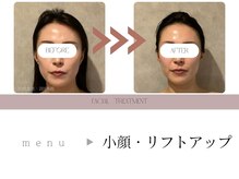 即実感♪ラジオ波+顔キャビで理想のフェイスラインに☆