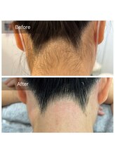 アート 熊本並木坂店(ART)/うなじ脱毛/フラッシュワックス