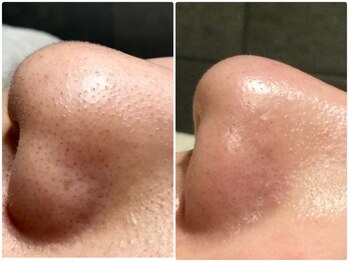 ユジュ(yju)の写真/【人気No.1コース☆】SNSで話題の韓国式毛穴ケアで毛穴レスのツルツル透明肌に◎通うほど透明感もアップ★