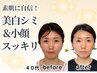 【若見え-５歳顔】韓国美白シミ＋小顔矯正11000