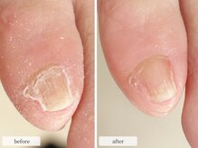 ディグニティ(Dignity)/フットネイルケア/副爪ケア