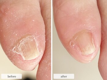 ディグニティ(Dignity)/フットネイルケア/副爪ケア