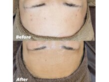 サロンドシェフィア(Salon de Chefia)/40代女性 症例写真