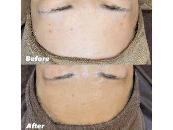 サロンドシェフィア(Salon de Chefia)/40代女性 症例写真