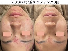 サロンヴェアリー 広尾(salon vary)/テクスパ8回施術