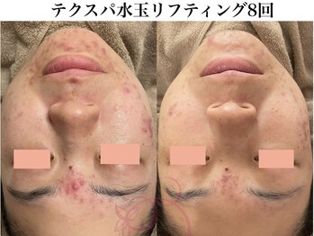 サロンヴェアリー 広尾(salon vary)/テクスパ8回施術
