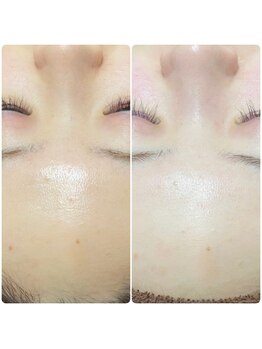 メロスの写真/ダクトピールで肌のトーンアップ、毛穴のお悩み解消へ!低刺激の次世代ピーリング