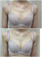 バーディー(BIRDIE)/施術１回/2０代