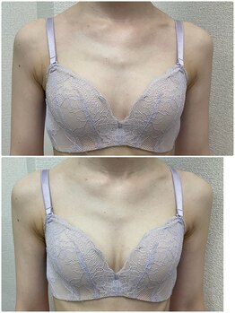 バーディー(BIRDIE)/施術１回/2０代