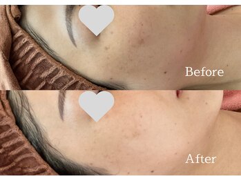 綺麗サロン 脱毛アンドフェイシャル ジュエル(Jewel)/【ポイントシミケア】