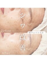 オーキッド(ORCHID)/光フェイシャルでシワ改善！