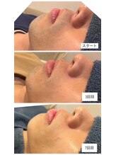 リノ(LINO)/結果重視！LINOのヒゲ脱毛