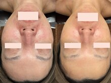 ラポーム(La paume)/赤みなど肌トラブルにお悩みの方