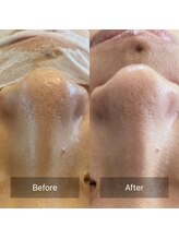 テセラ(TETHERA)/ナノテクノロジーフェイシャル