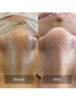 テセラ(TETHERA)/ナノテクノロジーフェイシャル