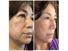 幹細胞導入でさらに若々しく美しく