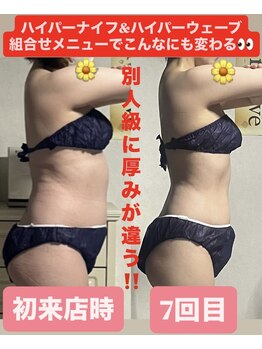 痩身ハイパーナイフメンズ【salon blue rose】新栄町/千種/痩身/ダイエット/脂肪燃焼/名古屋痩身/女性痩身/年齢問わず