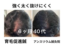 アンスリウム美容整体院 鍼灸院 接骨院の雰囲気（鍼で頭皮環境改善。専用剤等で変わらなかった方のご来院多数。）
