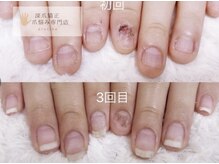 グラシナ 名古屋金山店/(深爪／長さだし/フィルイン)