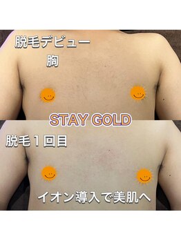 ステイゴールド 新百合ヶ丘(STAY GOLD)/胸毛はいらない!!メンズ脱毛!