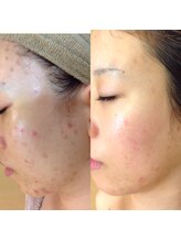 エステ ド モモコ/ニキビ肌