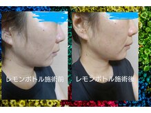 リラクゼーションサロン アールズ(R's)/韓国最新美容★レモンボトル