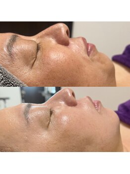 ヴィナーレ(VINARE)/ドクターリセラ/肌改善