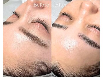 ポアラ(POARA)/毛穴/ワックス脱毛