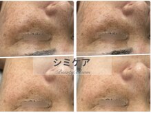 ビューティーブルーム(BeautyBloom)の雰囲気（ダウンタイムのないプラズマニアでシミケアで薄く★）