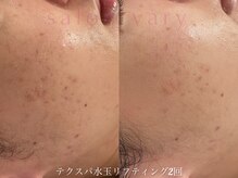 サロンヴェアリー 広尾(salon vary)/LDM水玉リフティングテクスパ2回