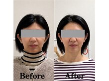 マルウル(maluulu)の雰囲気（トーンアップ、シャープな顎、引き締まった小顔（40代／12回目））
