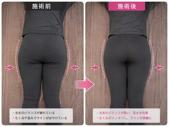 ヨサパーク アカーシャ(YOSA PARK AKASHA)/歪みを整えて左右差スッキリ