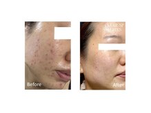 フォーティチュード(FORTITUDE)/光照射とホームケアでニキビ改善