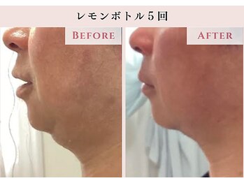 レクラ バイ ドクターエイチ(L'ECLAT by Doctor.H)/レモンボトル