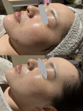 ウルソワン 都島店(/ulu soin)/ニキビ改善3回