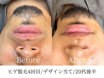 ラジター 江坂(LAZITER)/メンズヒゲ脱毛/デザイン当て