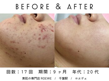 ロエヴェ(ROEWE)/ニキビ改善・毛穴ケア・肌質改善