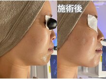 エヴァル 久留米店(ewalu)/温熱小顔リフト