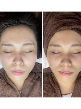 白雲木/日焼け後の肌もリセット