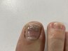 【強度の巻き爪の方に】巻き爪矯正（親指1本ワイヤー）11,000円